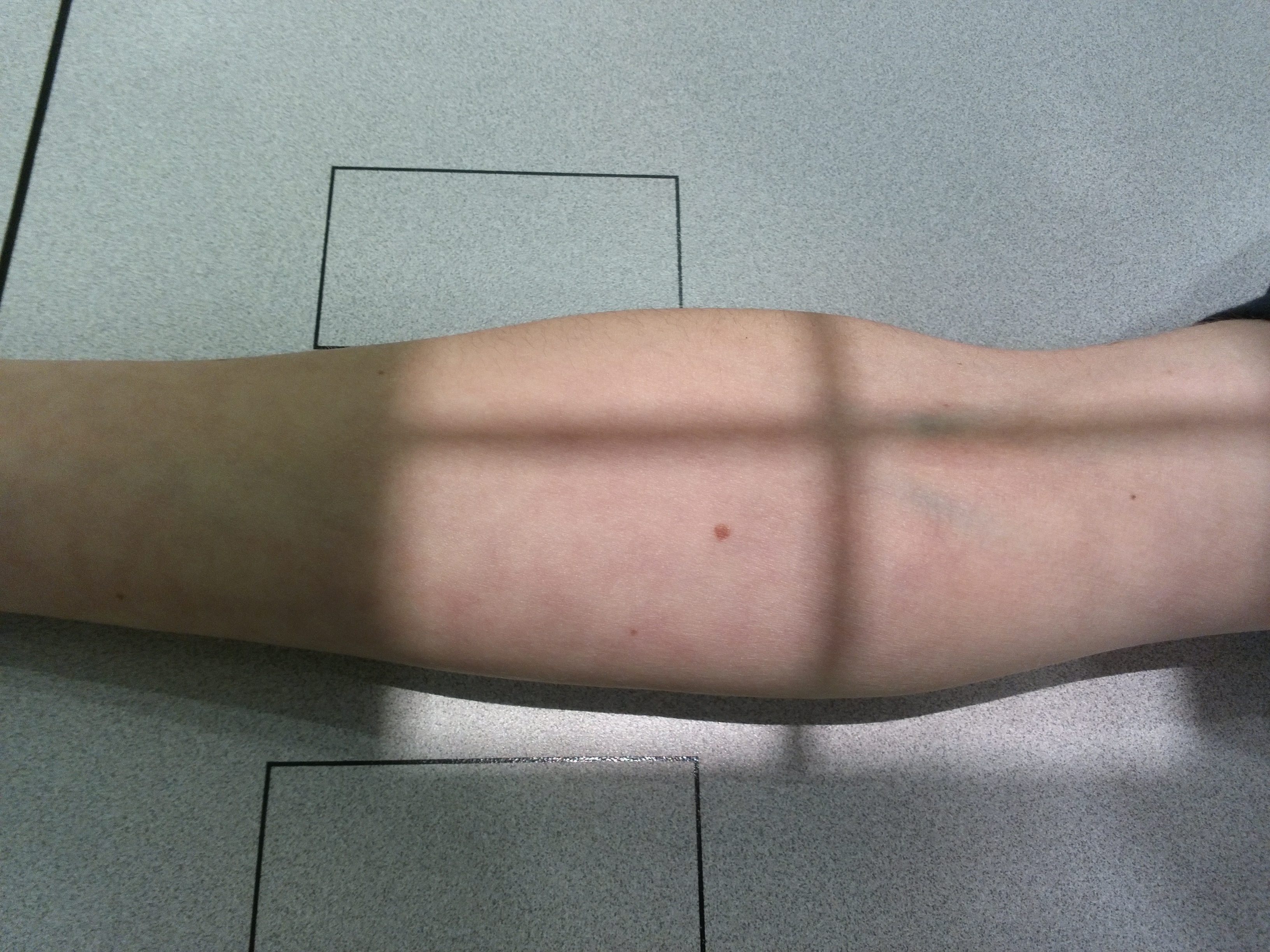 Radiografía AP Codo